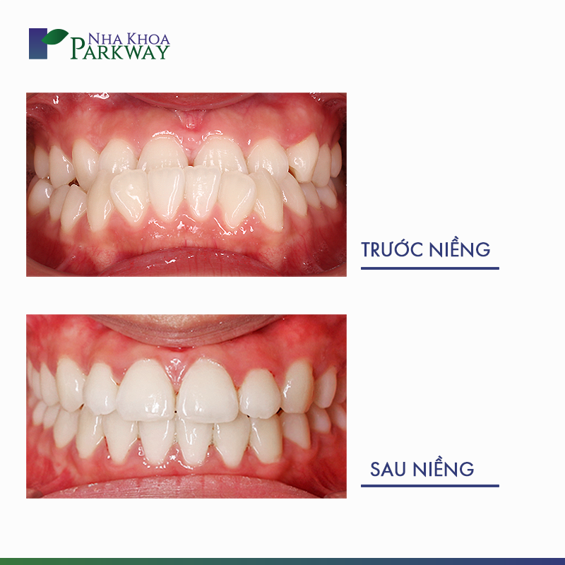 hình ảnh trước và sau khi niềng răng Invisalign