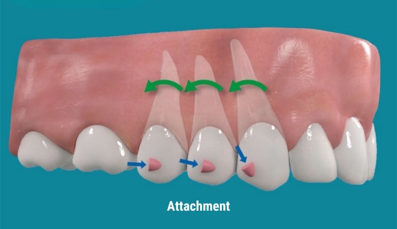 Khí cụ niềng răng chỉnh nha - 13