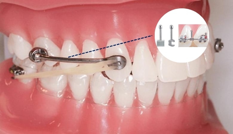 Khí cụ niềng răng chỉnh nha - 5