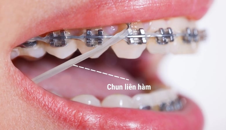 Khí cụ niềng răng chỉnh nha - 7