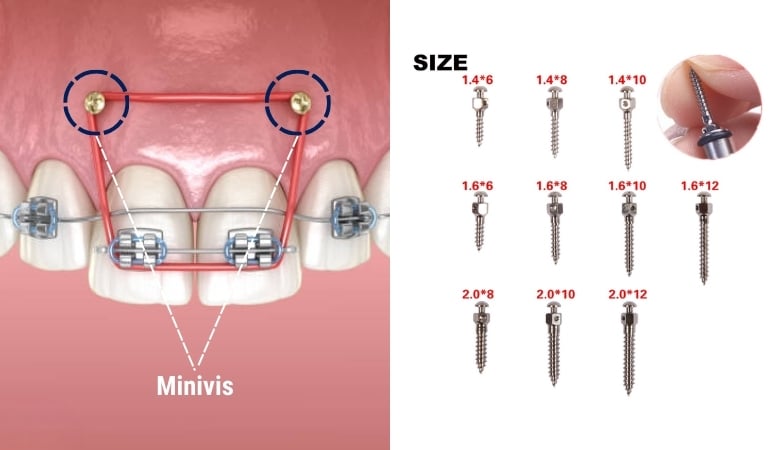 Khí cụ niềng răng chỉnh nha - 8