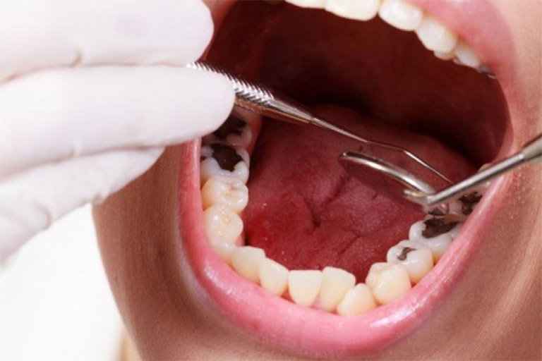 Máy điều trị tủy răng là gì?