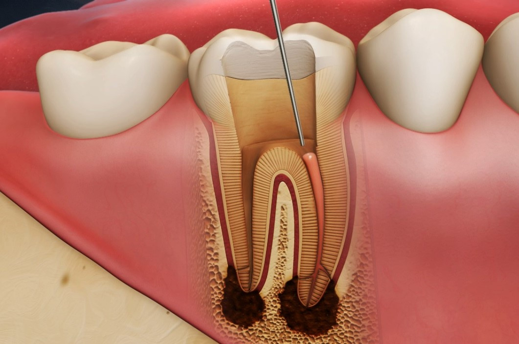 máy điều trị tủy răng giúp rút ngắn thời gian điều trị