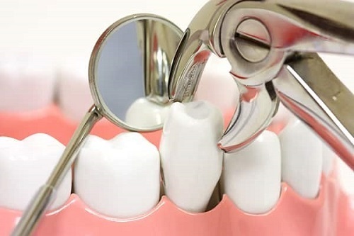 Nhổ răng số 4 để niềng răng có ảnh hưởng không?