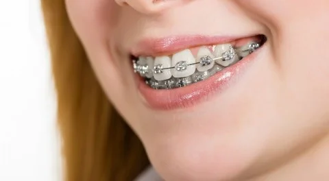 Nhổ răng số 4 để niềng có gây ảnh hưởng không