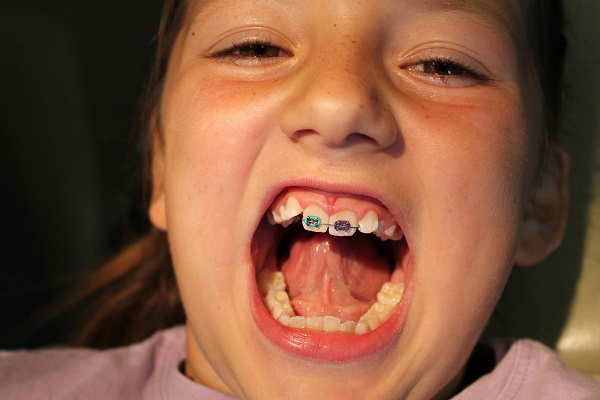 Niềng răng 1 cái: Răng cửa to và lệch