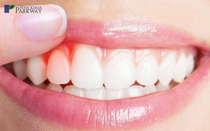 biến chứng tụt lợi khi niềng răng