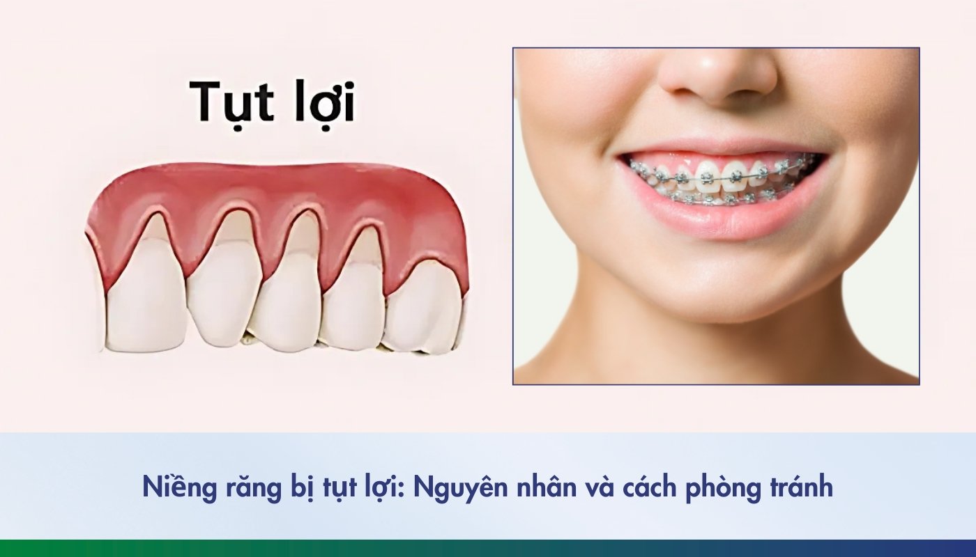 Niềng răng bị tụt lợi: Nguyên nhân và cách phòng tránh