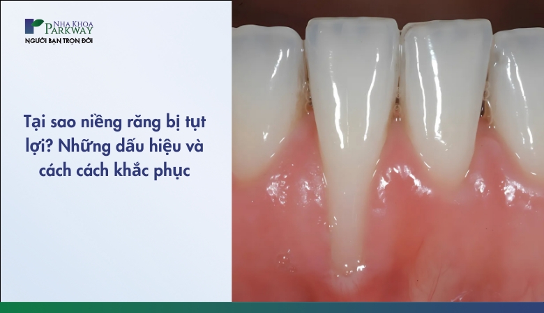 niềng răng bị tụt lợi - 1