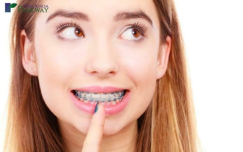 Khi nào cần phải nhổ răng khi niềng?
