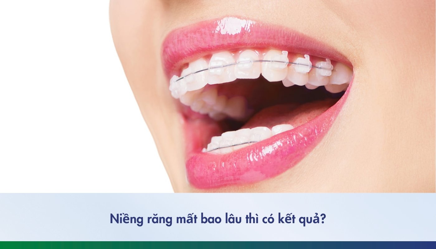 Niềng răng mất bao lâu có kết quả - 6