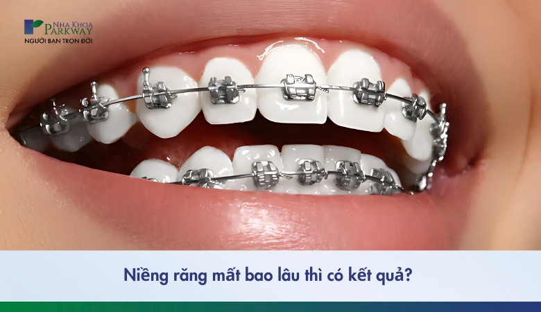 niềng răng mất bao lâu - 1