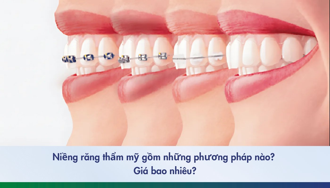 Niềng răng thẩm mỹ - 1