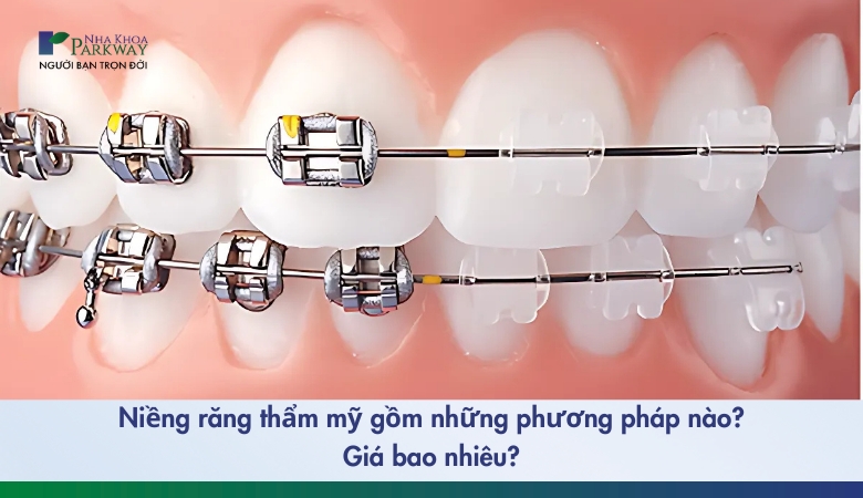 Niềng răng thẩm mỹ gồm những phương pháp nào