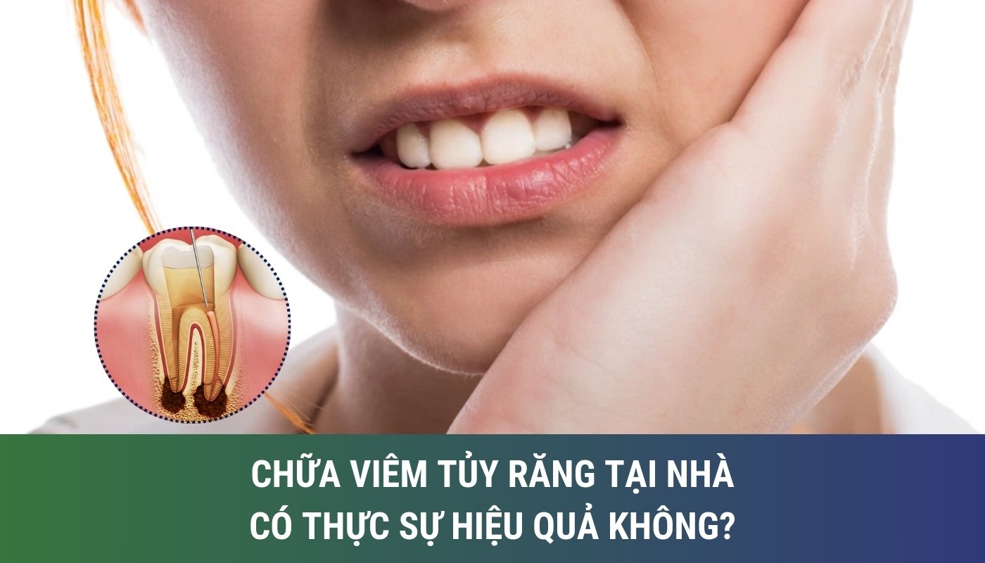 Chữa viêm tủy răng tại nhà có thực sự hiệu quả? Mẹo giúp giảm đau tại nhà khi răng bị viêm tủy