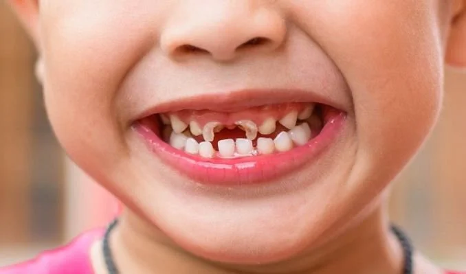 cách điều trị tủy răng ở trẻ em 