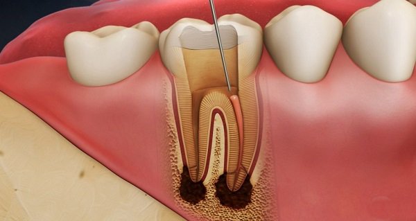 cách điều trị tủy răng tại nhà