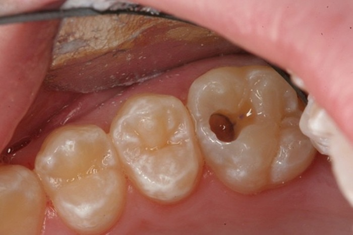 Điều trị tủy răng mất bao lâu