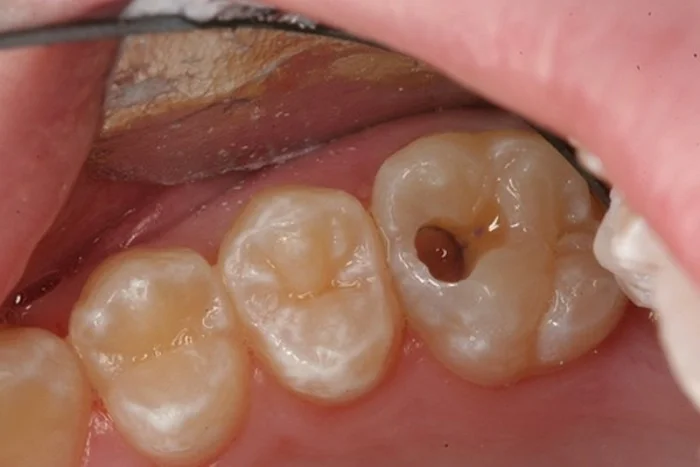 Điều trị tủy răng mất bao lâu