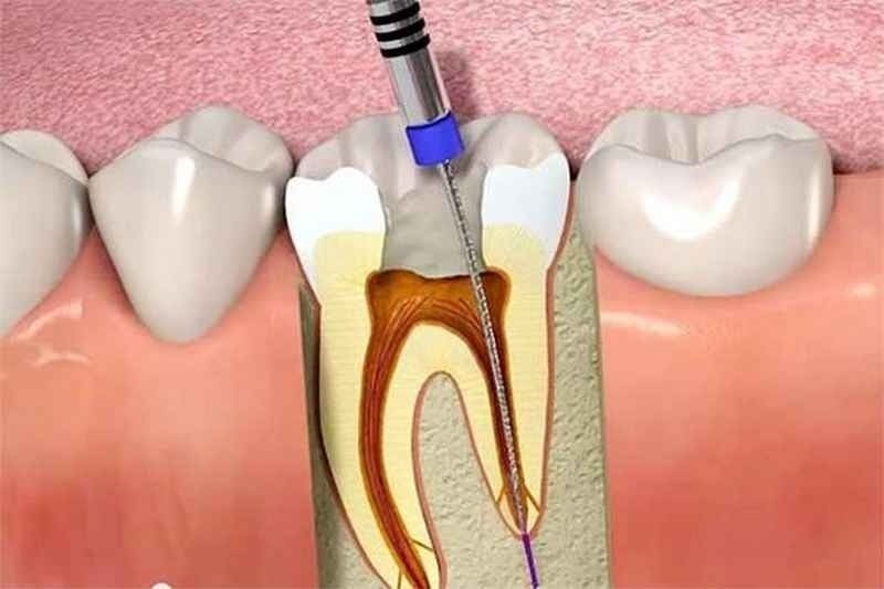 Điều trị tủy răng thất bại