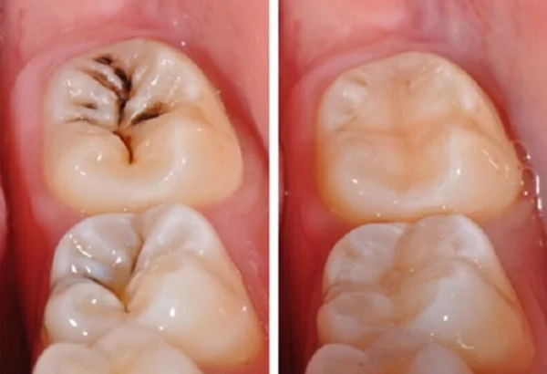 điều trị viêm tủy răng không hồi phụ