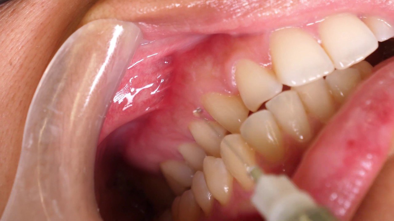 Kỹ thuật gây tê trong điều trị tủy răng