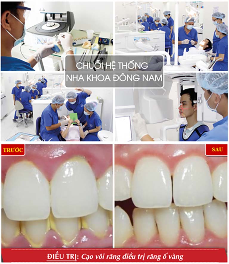 Lấy vôi răng tại TP.HCM