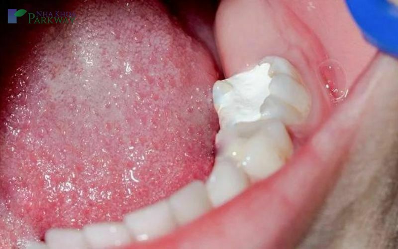 Miếng trám răng bị vỡ nên làm gì?