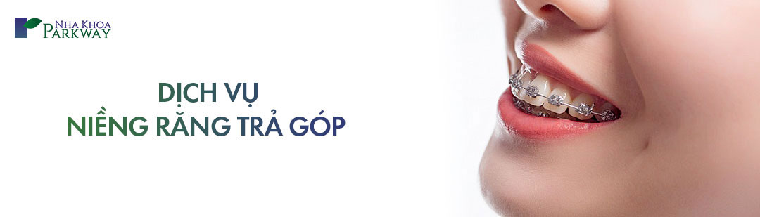 Dịch vụ niềng răng trả góp