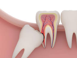 răng khôn bị sâu vỡ nên làm gì?