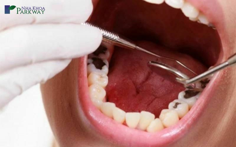 Trám răng tại nha khoa