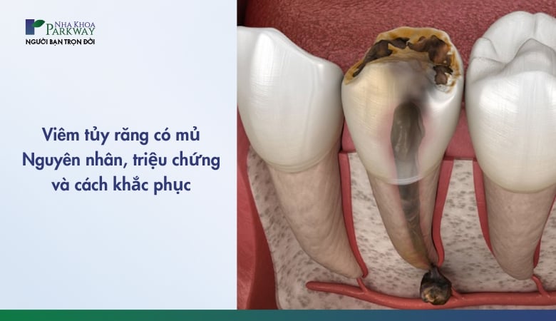 viêm tủy răng có mủ - 3