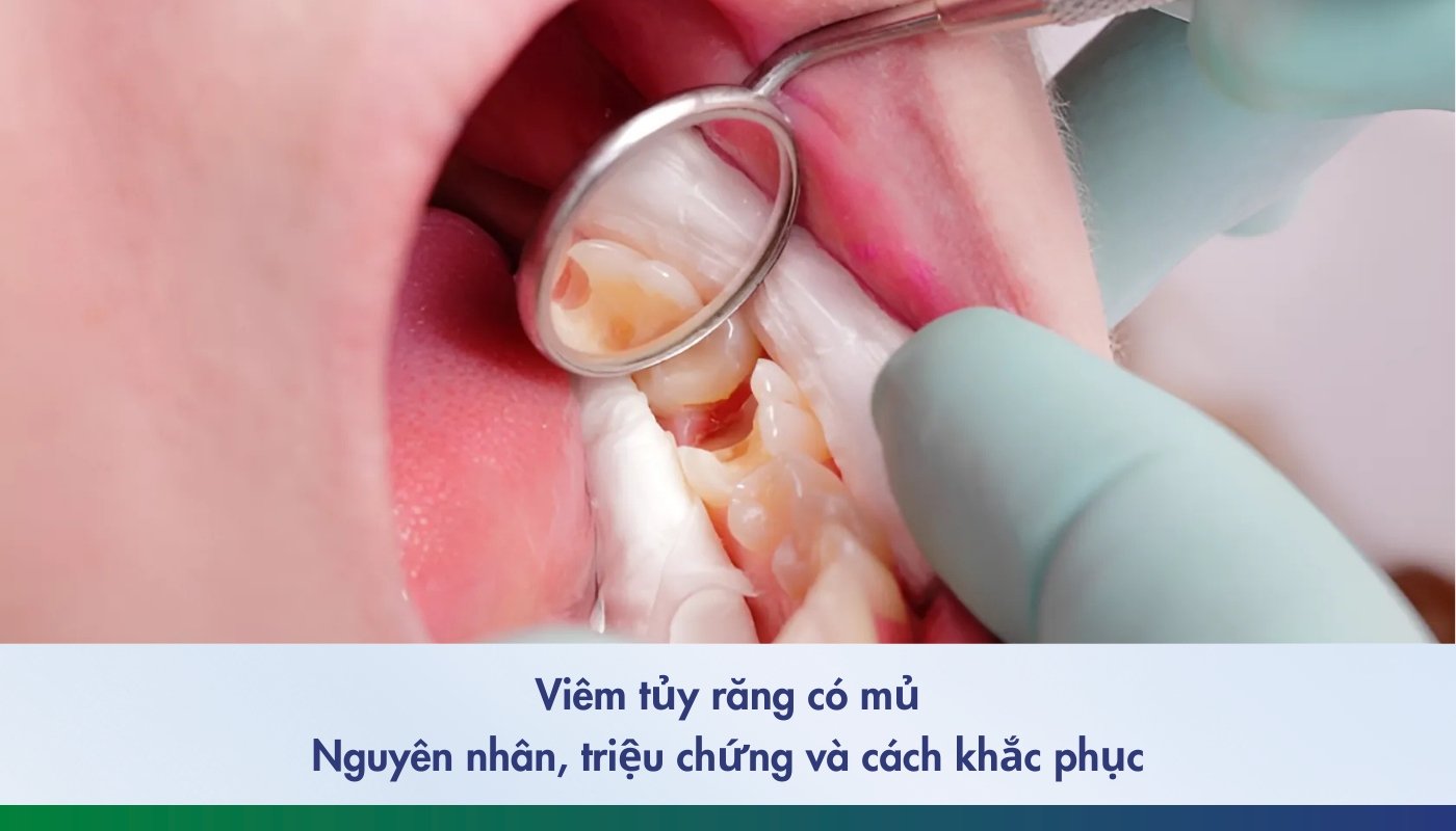 viêm tủy răng có mủ - 1