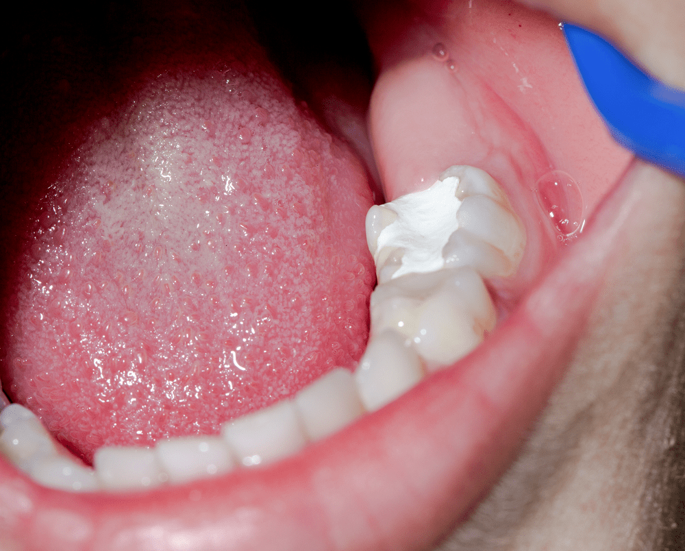 viêm tủy răng số 7