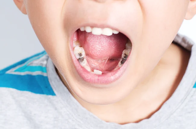 xịt chống sâu răng có tác dụng gì?
