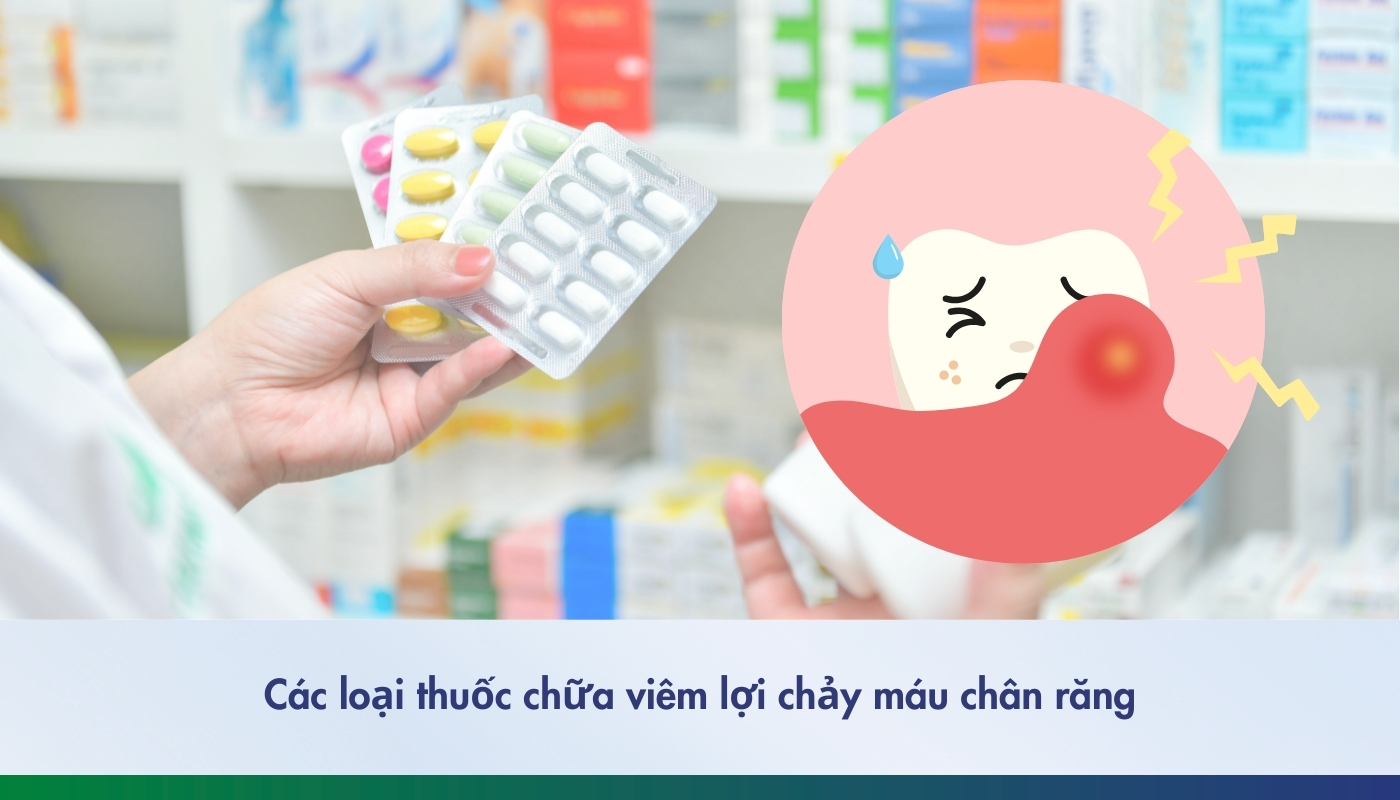 Viêm lợi uống thuốc gì