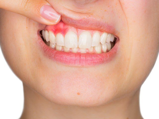 bà bầu bị chảy máu chân răng nhiều 