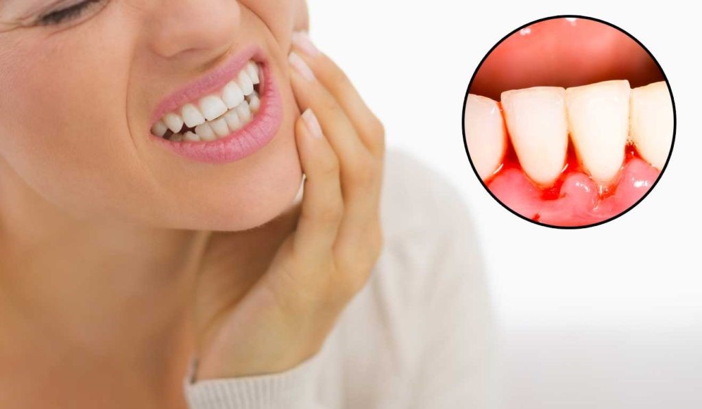 Cách chữa viêm lợi chảy máu chân răng cho bà bầu