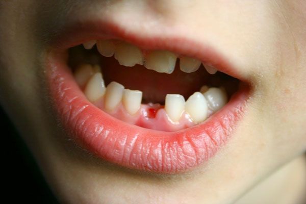 Dấu hiệu nhiễm trùng sau khi nhổ răng