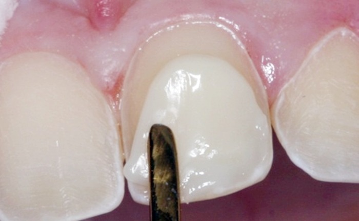 hàn răng bằng composite