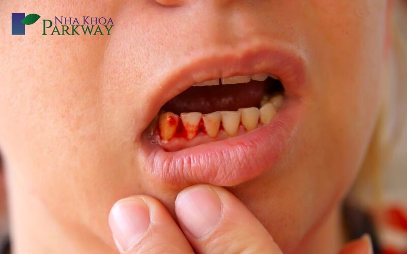 Sốt xuất huyết chảy máu chân răng có nguy hiểm không?