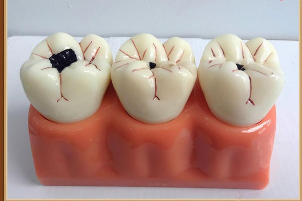 Trám răng hay bọc sứ tốt hơn?