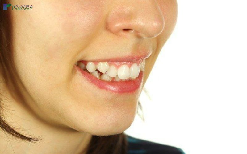 Trồng răng khểnh, răng khểnh là nét duyên dáng rất được ưa chuộng ở các nước phương Đông