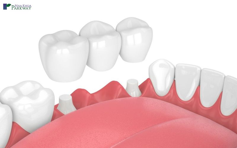 Trồng răng khểnh bằng phương pháp bắc cầu răng sứ