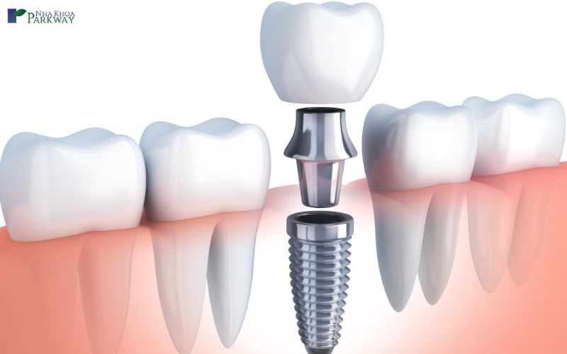 Trồng răng khểnh bằng phương pháp cấy ghép Implant
