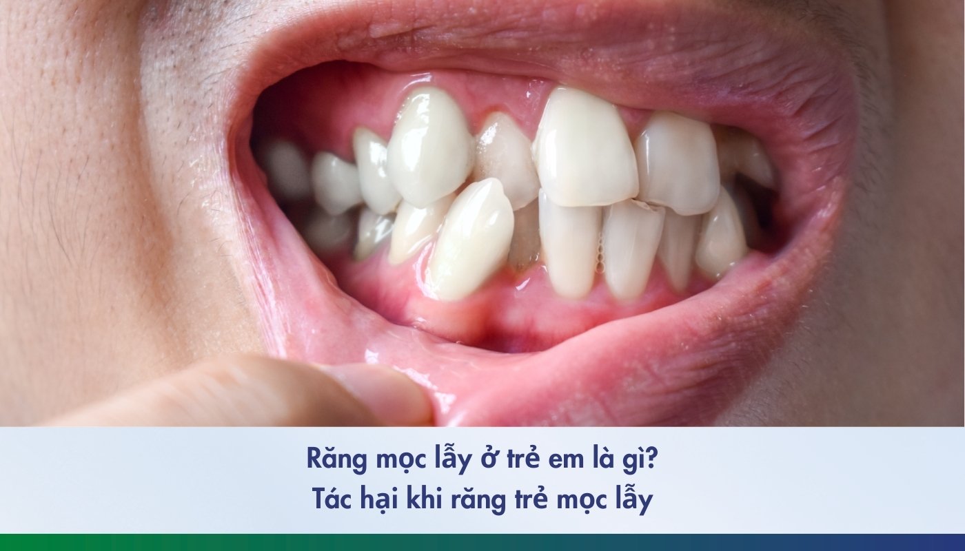 Tác hại khi răng mọc lẫy ở trẻ em