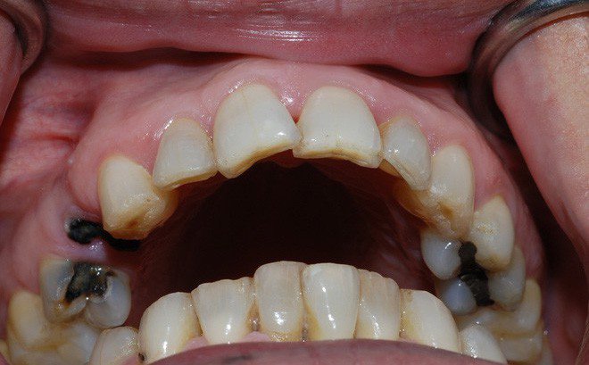 bé bị sâu răng hàm