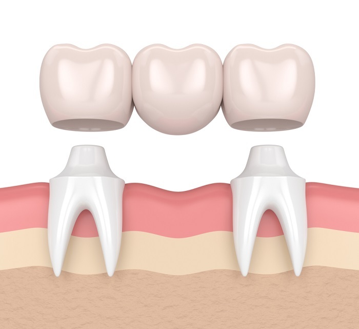 Bọc răng sứ dính liền tốt hơn hay nên bọc răng sứ rời từng cái?