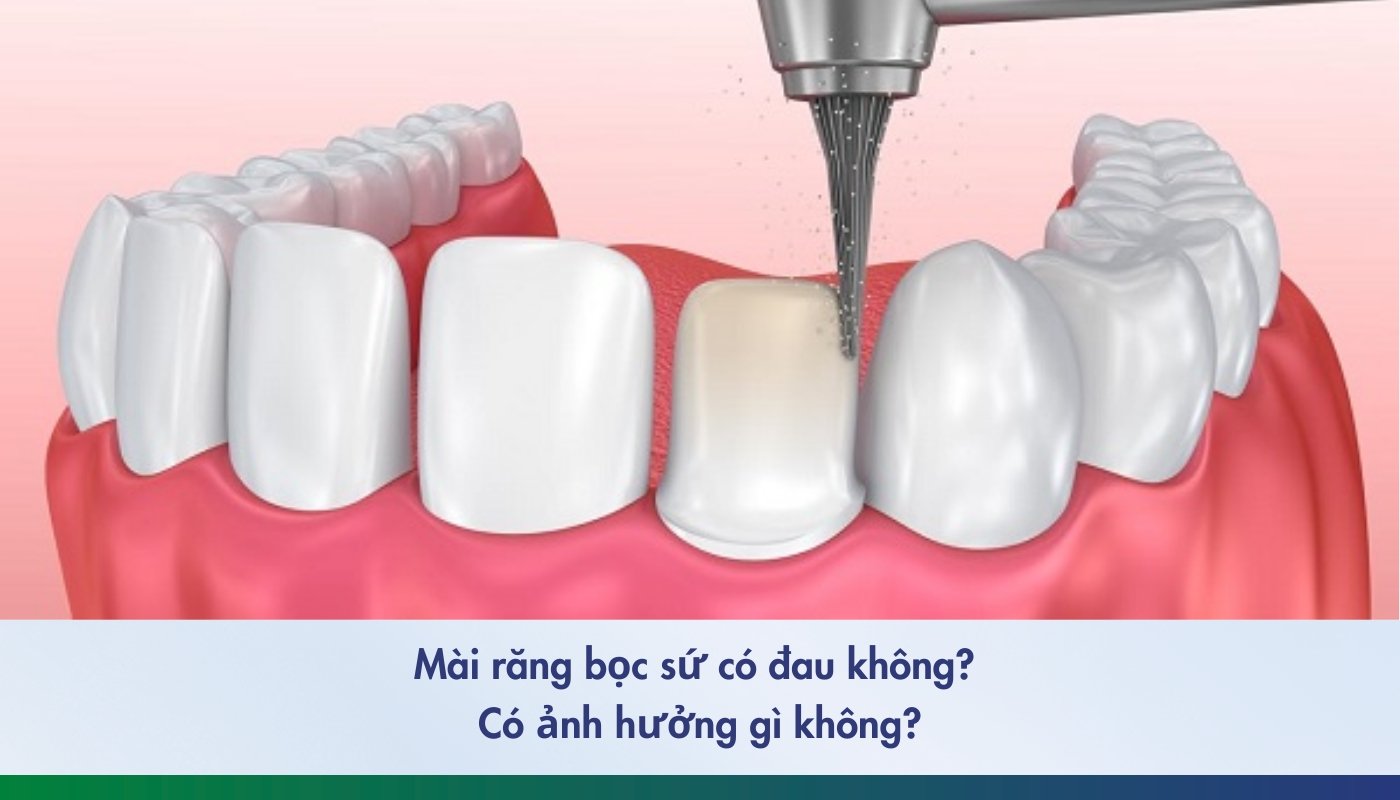 Mài răng bọc sứ 2