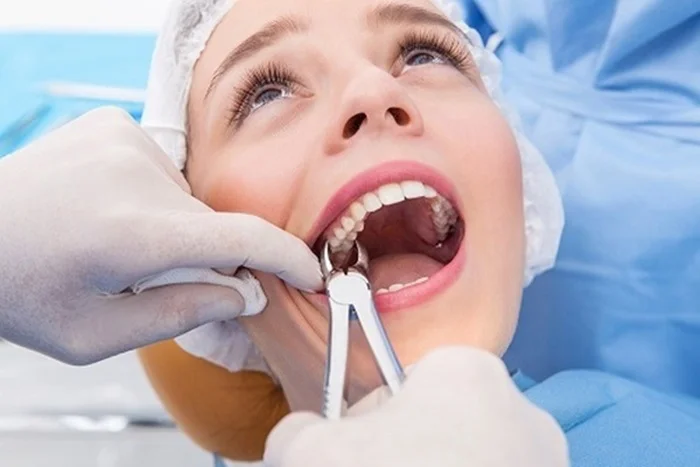 Nhổ răng cấm hàm trên có nguy hiểm không?